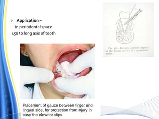  Application –
in periodontal space
450 to long axis of tooth
Placement of gauze between finger and
lingual side, for protection from injury in
case the elevator slips
 