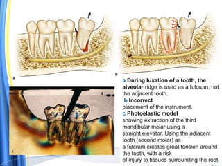 a During luxation of a tooth, the
alveolar ridge is used as a fulcrum, not
the adjacent tooth.
b Incorrect
placement of the instrument.
c Photoelastic model
showing extraction of the third
mandibular molar using a
straight elevator. Using the adjacent
tooth (second molar) as
a fulcrum creates great tension around
the tooth, with a risk
of injury to tissues surrounding the root
 