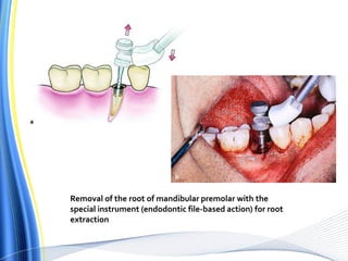 Removal of the root of mandibular premolar with the
special instrument (endodontic file-based action) for root
extraction
 