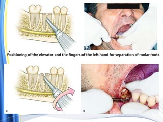 Positioning of the elevator and the fingers of the left hand for separation of molar roots
 