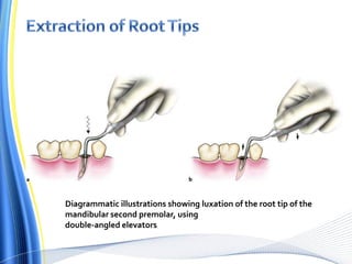 Diagrammatic illustrations showing luxation of the root tip of the
mandibular second premolar, using
double-angled elevators
 