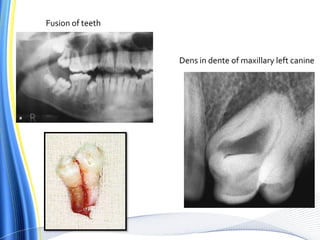 Dens in dente of maxillary left canine
Fusion of teeth
 