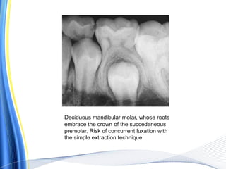 Deciduous mandibular molar, whose roots
embrace the crown of the succedaneous
premolar. Risk of concurrent luxation with
the simple extraction technique.
 