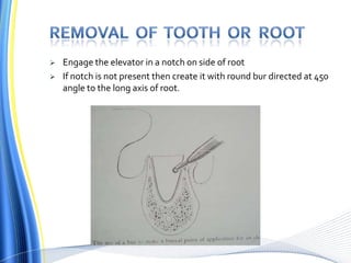  Engage the elevator in a notch on side of root
 If notch is not present then create it with round bur directed at 450
angle to the long axis of root.
 