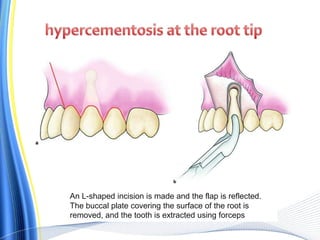 An L-shaped incision is made and the flap is reflected.
The buccal plate covering the surface of the root is
removed, and the tooth is extracted using forceps
 