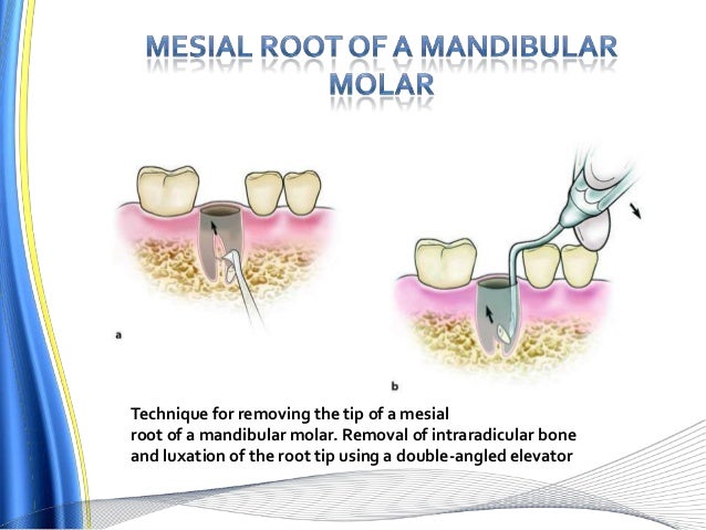 exodontia-73-638.jpg?cb=1439736881