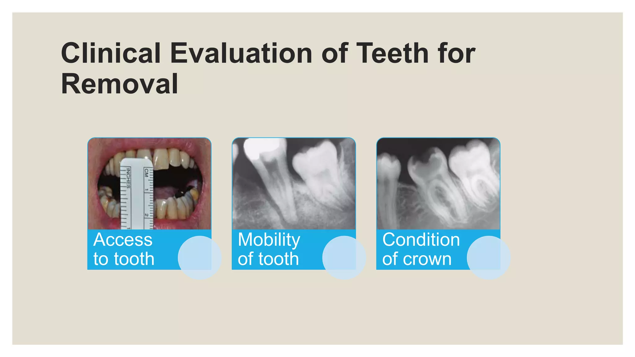 Clinical Evaluation of Teeth for
Removal
Access
to tooth
Mobility
of tooth
Condition
of crown
 