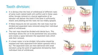 Splayed Tooth Roots Exodontia | PPTX