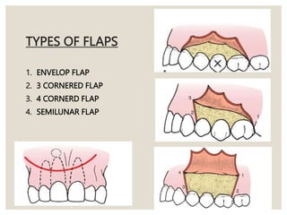 TYPES OF FLAPS
1. ENVELOP FLAP
2. 3 CORNERED FLAP
3. 4 CORNERD FLAP
4. SEMILUNAR FLAP
 
