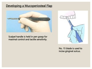 Developing a Mucoperiosteal Flap
Scalpel handle is held in pen grasp for
maximal control and tactile sensitivity.
No. 15 blade is used to
incise gingival sulcus.
 