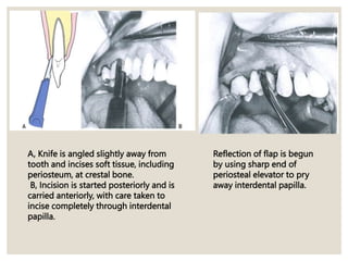 A, Knife is angled slightly away from
tooth and incises soft tissue, including
periosteum, at crestal bone.
B, Incision is started posteriorly and is
carried anteriorly, with care taken to
incise completely through interdental
papilla.
Reflection of flap is begun
by using sharp end of
periosteal elevator to pry
away interdental papilla.
 