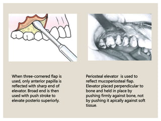 When three-cornered flap is
used, only anterior papilla is
reflected with sharp end of
elevator. Broad end is then
used with push stroke to
elevate posterio superiorly.
Periosteal elevator is used to
reflect mucoperiosteal flap.
Elevator placed perpendicular to
bone and held in place by
pushing firmly against bone, not
by pushing it apically against soft
tissue.
 