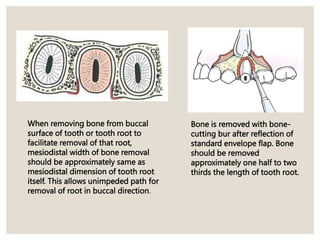 When removing bone from buccal
surface of tooth or tooth root to
facilitate removal of that root,
mesiodistal width of bone removal
should be approximately same as
mesiodistal dimension of tooth root
itself. This allows unimpeded path for
removal of root in buccal direction.
Bone is removed with bone-
cutting bur after reflection of
standard envelope flap. Bone
should be removed
approximately one half to two
thirds the length of tooth root.
 