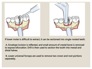 If lower molar is difficult to extract, it can be sectioned into single-rooted teeth.
A, Envelope incision is reflected, and small amount of crestal bone is removed
to expose bifurcation. Drill is then used to section the tooth into mesial and
distal halves.
B, Lower universal forceps are used to remove two crown and root portions
separately.
 
