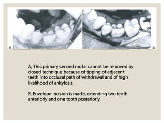 A, This primary second molar cannot be removed by
closed technique because of tipping of adjacent
teeth into occlusal path of withdrawal and of high
likelihood of ankylosis.
B, Envelope incision is made, extending two teeth
anteriorly and one tooth posteriorly.
 