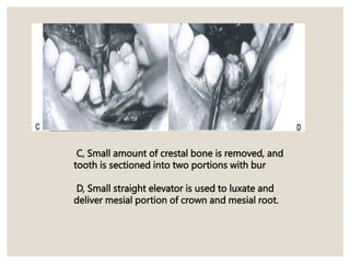 C, Small amount of crestal bone is removed, and
tooth is sectioned into two portions with bur
D, Small straight elevator is used to luxate and
deliver mesial portion of crown and mesial root.
 