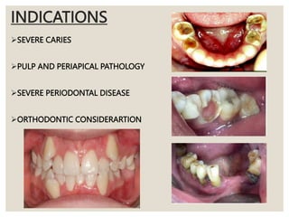 INDICATIONS
SEVERE CARIES
PULP AND PERIAPICAL PATHOLOGY
SEVERE PERIODONTAL DISEASE
ORTHODONTIC CONSIDERARTION
 