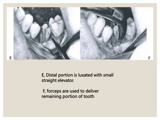 E, Distal portion is luxated with small
straight elevator.
F, forceps are used to deliver
remaining portion of tooth
 