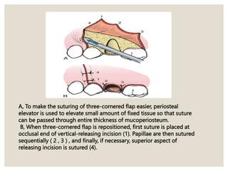 A, To make the suturing of three-cornered flap easier, periosteal
elevator is used to elevate small amount of fixed tissue so that suture
can be passed through entire thickness of mucoperiosteum.
B, When three-cornered flap is repositioned, first suture is placed at
occlusal end of vertical-releasing incision (1). Papillae are then sutured
sequentially ( 2 , 3 ) , and finally, if necessary, superior aspect of
releasing incision is sutured (4).
 