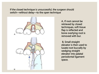 If the closed technique is unsuccessful, the surgeon should
switch—without delay—to the open technique
A, If root cannot be
retrieved by closed
techniques, soft tissue
flap is reflected and
bone overlying root is
removed with bur.
B, Small straight
elevator is then used to
luxate root buccally by
wedging straight
elevator into palatal
periodontal ligament
space.
 