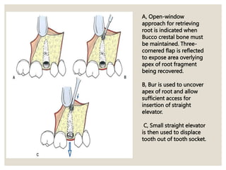 A, Open-window
approach for retrieving
root is indicated when
Bucco crestal bone must
be maintained. Three-
cornered flap is reflected
to expose area overlying
apex of root fragment
being recovered.
B, Bur is used to uncover
apex of root and allow
sufficient access for
insertion of straight
elevator.
C, Small straight elevator
is then used to displace
tooth out of tooth socket.
 