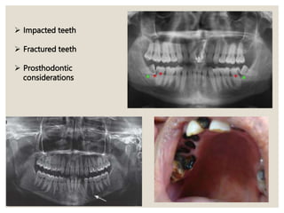  Impacted teeth
 Fractured teeth
 Prosthodontic
considerations
 