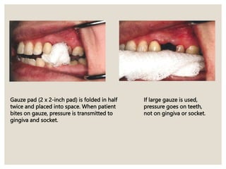 Gauze pad (2 x 2-inch pad) is folded in half
twice and placed into space. When patient
bites on gauze, pressure is transmitted to
gingiva and socket.
If large gauze is used,
pressure goes on teeth,
not on gingiva or socket.
 