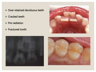 Over retained deciduous teeth
 Cracked teeth
 Pre radiation
 Fractured tooth
 