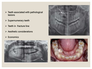  Teeth associated with pathological
lesions
 Supernumerary teeth
 Teeth in fracture line
 Aesthetic considerations
 Economics
 
