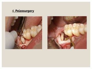 4. Peizosurgery
 