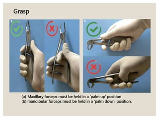 (a) Maxillary forceps must be held in a ‘palm up’ position
(b) mandibular forceps must be held in a ‘palm down’ position.
Grasp
 