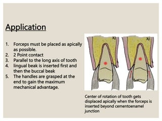 Application
1. Forceps must be placed as apically
as possible.
2. 2 Point contact
3. Parallel to the long axis of tooth
4. lingual beak is inserted first and
then the buccal beak
5. The handles are grasped at the
end to gain the maximum
mechanical advantage.
Center of rotation of tooth gets
displaced apically when the forceps is
inserted beyond cementoenamel
junction
 