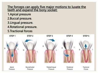 The forceps can apply five major motions to luxate the
teeth and expand the bony socket:
1.Apical pressure
2.Buccal pressure.
3.Lingual pressure.
4.Rotational pressure.
5.Tractional forces
 