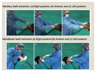 Maxillary teeth extraction, (a) Right posterior, (b) Anterior, and (c) Left posterior
Mandibular teeth extraction (a) Right posterior,(b) Anterior and (c) Left posterior
 