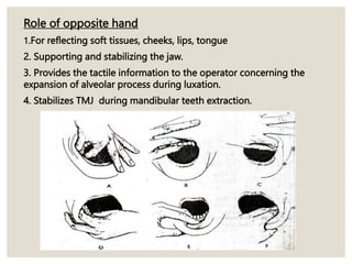 Role of opposite hand
1.For reflecting soft tissues, cheeks, lips, tongue
2. Supporting and stabilizing the jaw.
3. Provides the tactile information to the operator concerning the
expansion of alveolar process during luxation.
4. Stabilizes TMJ during mandibular teeth extraction.
 