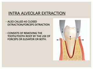 INTRA ALVEOLAR EXTRACTION
◦ ALSO CALLED AS CLOSED
EXTRACTION/FORCEPS EXTRACTION
◦ CONSISTS OF REMOVING THE
TOOTH/TOOTH ROOT BY THE USE OF
FORCEPS OR ELEVATOR OR BOTH.
 