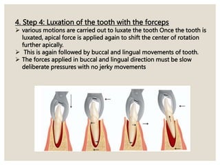 4. Step 4: Luxation of the tooth with the forceps
 various motions are carried out to luxate the tooth Once the tooth is
luxated, apical force is applied again to shift the center of rotation
further apically.
 This is again followed by buccal and lingual movements of tooth.
 The forces applied in buccal and lingual direction must be slow
deliberate pressures with no jerky movements
 