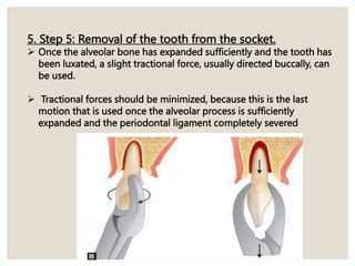 5. Step 5: Removal of the tooth from the socket.
 Once the alveolar bone has expanded sufficiently and the tooth has
been luxated, a slight tractional force, usually directed buccally, can
be used.
 Tractional forces should be minimized, because this is the last
motion that is used once the alveolar process is sufficiently
expanded and the periodontal ligament completely severed
 