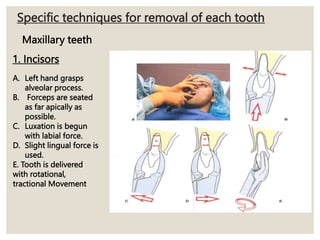 Specific techniques for removal of each tooth
1. Incisors
A. Left hand grasps
alveolar process.
B. Forceps are seated
as far apically as
possible.
C. Luxation is begun
with labial force.
D. Slight lingual force is
used.
E. Tooth is delivered
with rotational,
tractional Movement
Maxillary teeth
 