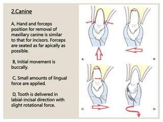 2.Canine
A, Hand and forceps
position for removal of
maxillary canine is similar
to that for incisors. Forceps
are seated as far apically as
possible.
B, Initial movement is
buccally.
C, Small amounts of lingual
force are applied.
D, Tooth is delivered in
labial-incisal direction with
slight rotational force.
 