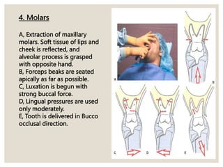 4. Molars
A, Extraction of maxillary
molars. Soft tissue of lips and
cheek is reflected, and
alveolar process is grasped
with opposite hand.
B, Forceps beaks are seated
apically as far as possible.
C, Luxation is begun with
strong buccal force.
D, Lingual pressures are used
only moderately.
E, Tooth is delivered in Bucco
occlusal direction.
 