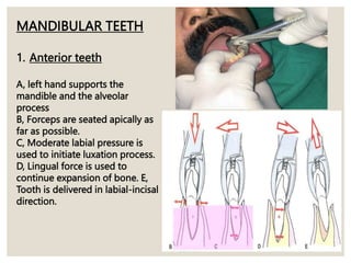 A
MANDIBULAR TEETH
1. Anterior teeth
A, left hand supports the
mandible and the alveolar
process
B, Forceps are seated apically as
far as possible.
C, Moderate labial pressure is
used to initiate luxation process.
D, Lingual force is used to
continue expansion of bone. E,
Tooth is delivered in labial-incisal
direction.
 