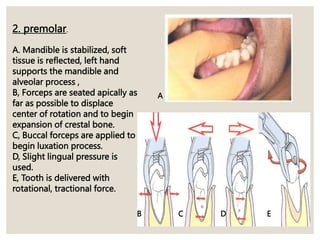 A
B C D E
2. premolar.
A. Mandible is stabilized, soft
tissue is reflected, left hand
supports the mandible and
alveolar process ,
B, Forceps are seated apically as
far as possible to displace
center of rotation and to begin
expansion of crestal bone.
C, Buccal forceps are applied to
begin luxation process.
D, Slight lingual pressure is
used.
E, Tooth is delivered with
rotational, tractional force.
 