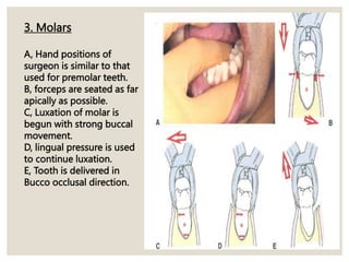 3. Molars
A, Hand positions of
surgeon is similar to that
used for premolar teeth.
B, forceps are seated as far
apically as possible.
C, Luxation of molar is
begun with strong buccal
movement.
D, lingual pressure is used
to continue luxation.
E, Tooth is delivered in
Bucco occlusal direction.
 