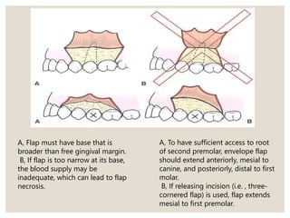 A, Flap must have base that is
broader than free gingival margin.
B, If flap is too narrow at its base,
the blood supply may be
inadequate, which can lead to flap
necrosis.
A, To have sufficient access to root
of second premolar, envelope flap
should extend anteriorly, mesial to
canine, and posteriorly, distal to first
molar.
B, If releasing incision (i.e. , three-
cornered flap) is used, flap extends
mesial to first premolar.
 