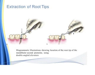 exodontia-ppt.pptx