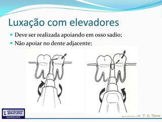 Luxação com elevadores
 Deve ser realizada apoiando em osso sadio;
 Não apoiar no dente adjacente;
 