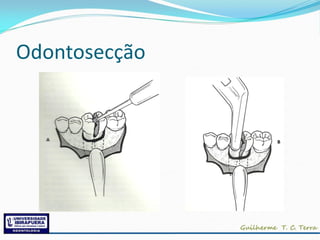 Odontosecção
 