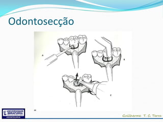 Odontosecção
 