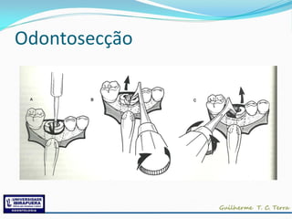 Odontosecção
 